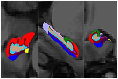 Unraveling the link: white matter damage, gray matter atrophy and memory impairment in patients with subcortical ischemic vascular disease